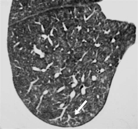 Tree In Bud Pattern At Thin Section CT Of The Lungs Radiologic