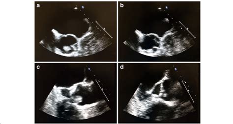 Transesophageal Echocardiography A B Transesophageal Echocardiography Download Scientific