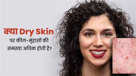 Dry Skin क्या ड्राई स्किन पर कील मुंहासे अधिक होते हैं जानें एक्सपर्ट