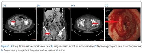 Metastatic Ovarian Cancer Mimicking A Primary Rectal Cancer A Case