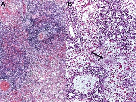 Spleen A And Lymph Node B With Lymphoid Tissue Depletion And Download Scientific Diagram