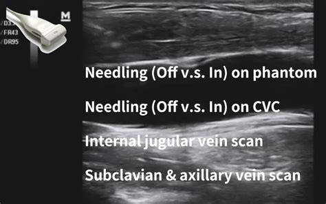 Pocus Academy Point Of Care Ultrasound Is The Visual Stethoscope In The 21st Century