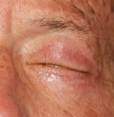 Eyelid Dermatitis Treatment Symptoms And Causes