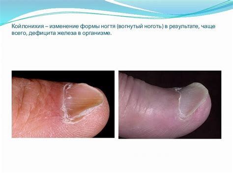 ЗАБОЛЕВАНИЯ НОГТЕЙ