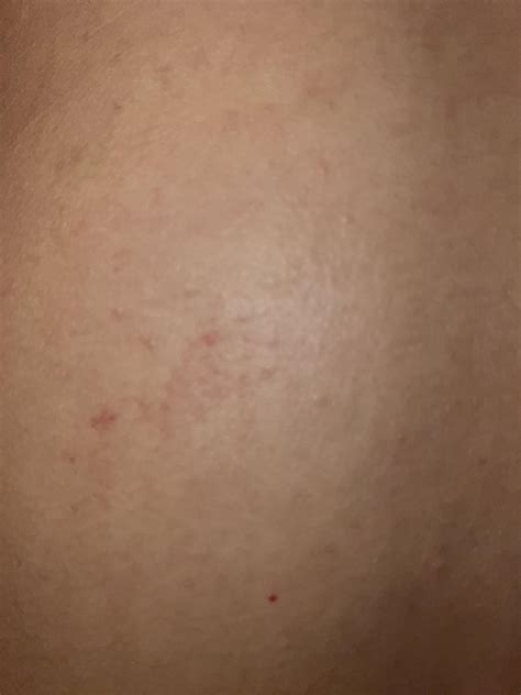 Doctors Said Pityriasis Rosea Rpityriasisrosea