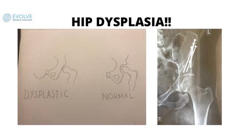 Hip Dysplasia What Is It Symptoms Diagnosis Treatment Youtube