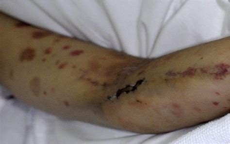 Purpuric Rash Over Upper And Lower Extremities Download Scientific Diagram