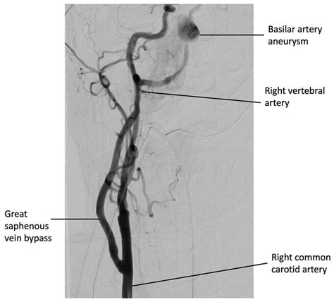 Digital Subtraction Angiography From The Right Common Carotid Artery