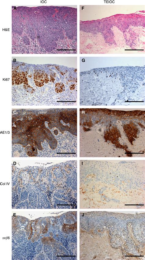 Representative Sections Of Early Invasive Oral Carcinoma IOC Taken