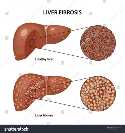 Representative Images Of Liver Histology Showing Stages Of Fibrosis Images