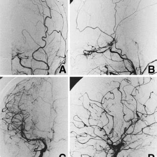 A Magnetic Resonance Mr Angiogram Demonstrating Left Internal