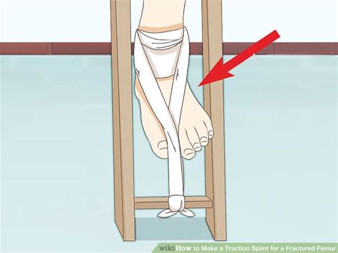 How To Make A Traction Splint For A Fractured Femur 10 Steps