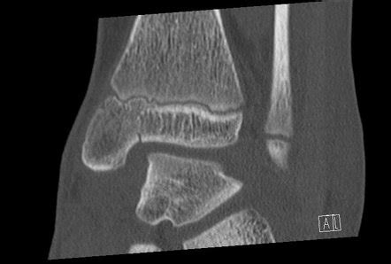 Salter Harris Type III Fracture Radiology Reference Article