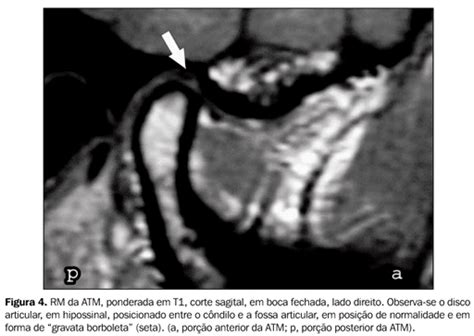 SciELO Brasil Articulação temporomandibular aspectos normais e