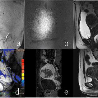 A 41-year-old woman who had a transverse incision scar presented with... | Download Scientific ...