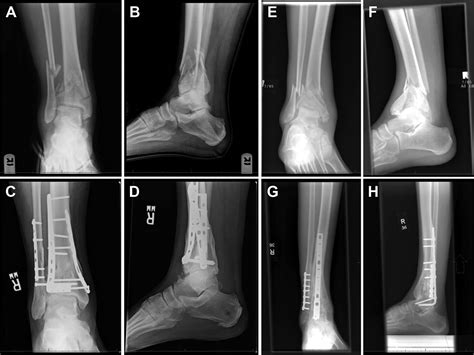 Primary Ankle Arthrodesis Vs Orif For Severely Comminuted Pilon