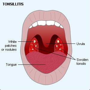 Swollen Tonsils - Symptoms, Causes, Pictures, Treatment and Home Remedies