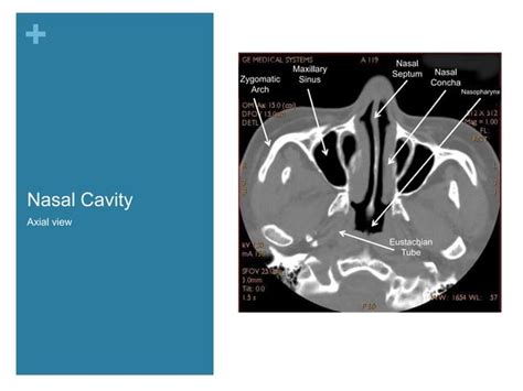 Nasal Cavity And Paranasal Sinuses Radiologic Anatomy Ppt