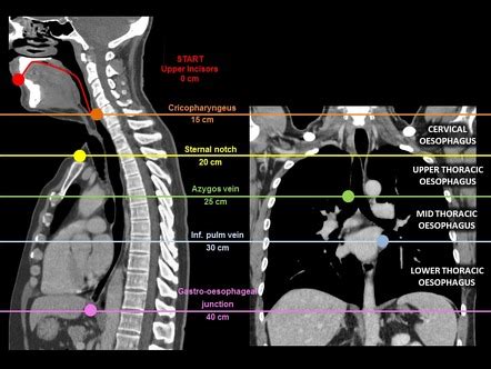 Esophagus Radiology Reference Article Radiopaedia Org