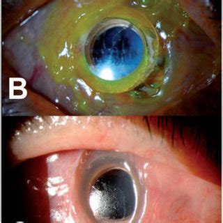 PDF The Usage Of A Conjunctival Flap To Improve Retention Of Boston