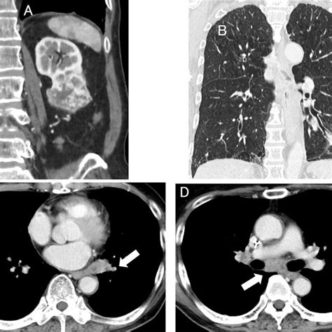 Contrast Enhanced Computed Tomographic Image At The First Visit A The