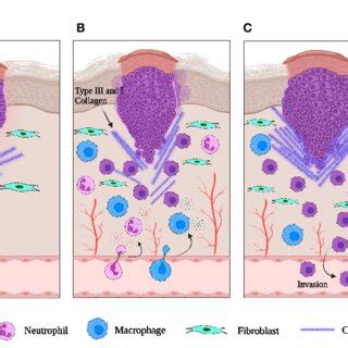 Schematic representation of an epithelial tumor. (A) When neoplasia is ...