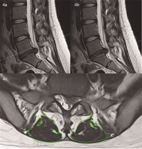 Details Of Cross Sectional Area Csa Measurements A The Supradiscal