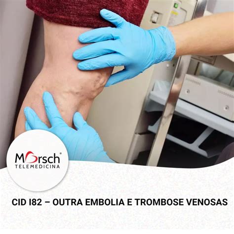 CID I82 é o código para Outra embolia e trombose venosas conforme a