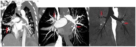 Diagnostics Free Full Text Ct Imaging Findings Of Pulmonary Artery Stenosis A Pictorial Review