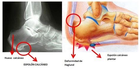 Qué es la osteocondrosis y la osteocondritis Demedicina