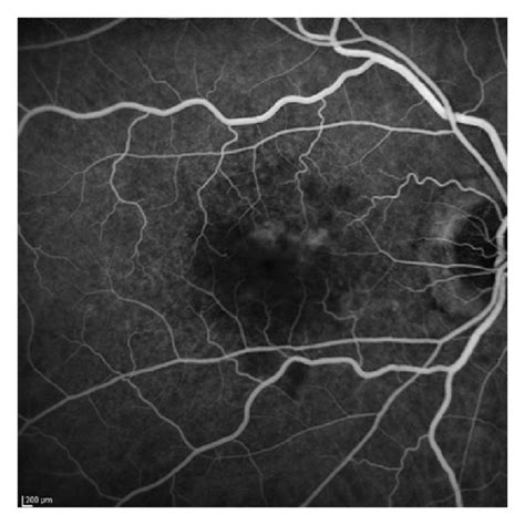 Early A And Late Phase B Fluorescein Angiography In An Eye With Dfo Download Scientific