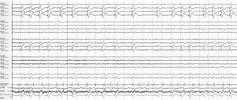 Fluctuating Lpds Lateralized Periodic Discharges That Fluctuate In