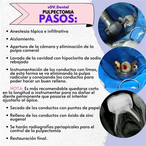 Pulpectomia Odontolog A Anestesia En Odontologia Escuela De