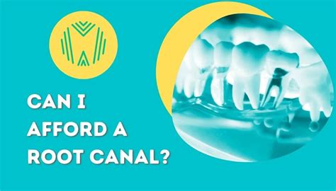 Understanding Root Canal Costs Affordable Options For Patients The