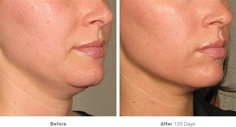 Ultherapy Before After Fairfax Va Impressions Medspa