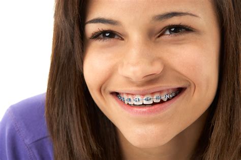 How To Get Rid Of White Spots On Teeth After Braces