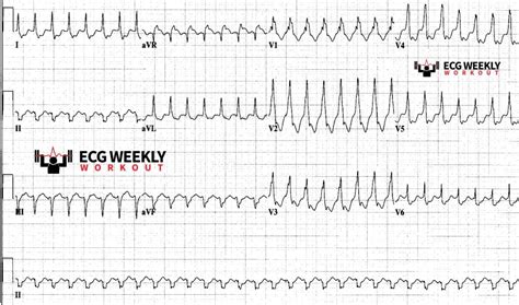 Wide Complex Tachycardias Can Ecg Algorithms Safely Rule Out Ventricular Tachycardia In The