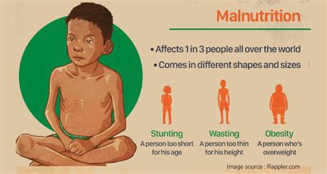 Pathophysiology Of Malnutrition Marasmus VS Kwashiorkor