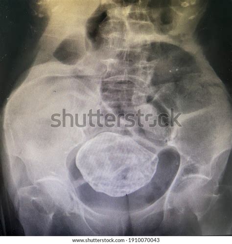 Stone Abdomen Calcified Uterine Leiomyoma Calcification Foto Stok 1910070043 Shutterstock