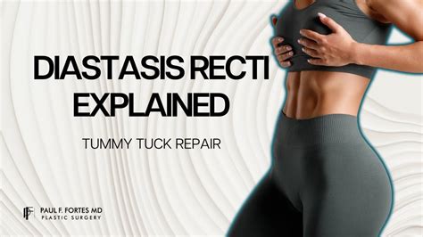 Diastasis Recti Explained Repairing Your Postpartum Core With A Tummy