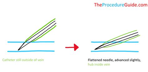 Peripheral Intravenous Access Iv Technique And Overview The