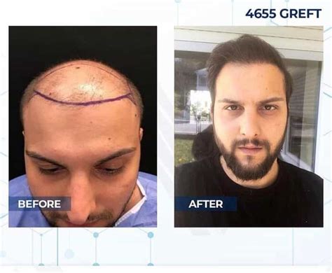 Fue Hair Transplant Cab Health Hair Transplant Turkey And Sweden