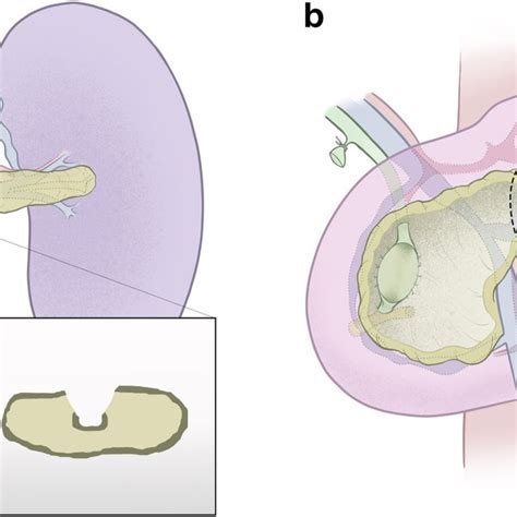 Whereas The Duodenum Preserving Pancreatic Head Resections Such As The Download Scientific