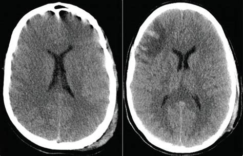 Diffuse Axonal Injury A Devastating Pathology Intechopen