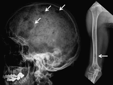 Multiple Myeloma X Ray - الورم النقوي العديد Multiple Myeloma | حكيم - Multiple myeloma is a ...