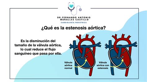 Estenosis aórtica YouTube