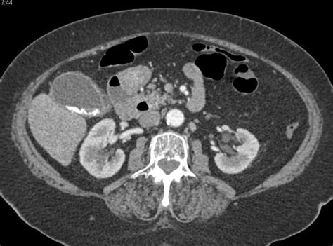 Obstructing Stone In Distal Common Bile Duct Cbd With Mirizzi