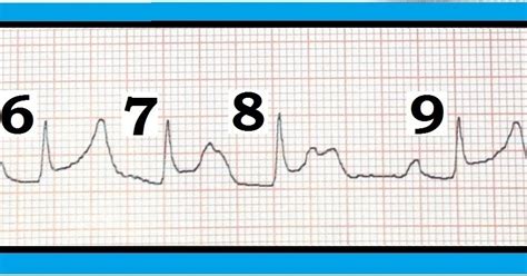 ECG Interpretation: ECG Interpretation Review #55 (Mobitz I - Mobitz II ...