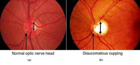 Figure 1 From Optic Disc And Optic Cup Segmentation Methodology For