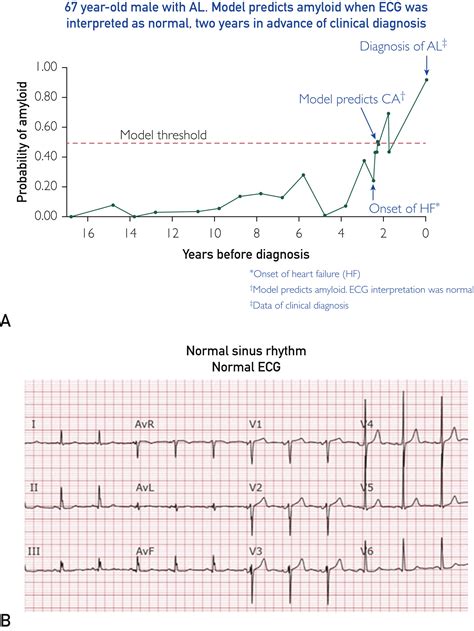 Artificial Intelligenceenhanced Electrocardiogram For The Early